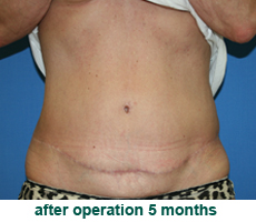 plastic-surgery-tummy-tuck